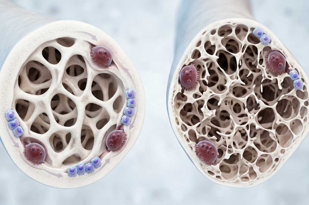 Osteoporose e Metabolismo Ósseo